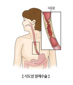 식도암 [출처: 서울아산병원]
