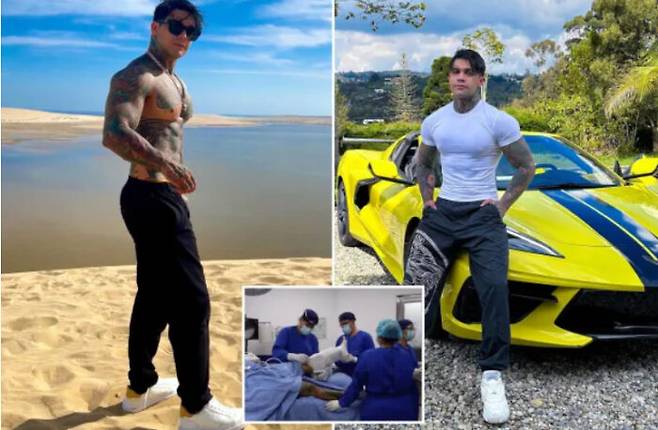 29세의 콜롬비아 출신 모델이자 인플루언서 남성이 키연장 수술을 받으면서 그 과정을 기록한 영상이 해외에서 화제를 모으고 있다. [사진=영국 더썬 보도내용 캡처]