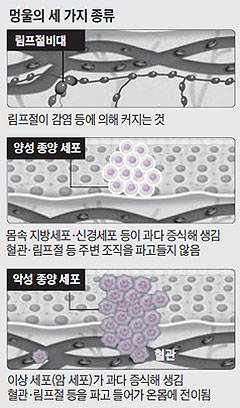 몸에 생기는 멍울은 크게 림프절비대, 양성 종양, 악성 종양 세 가지로 나뉜다./사진=헬스조선DB