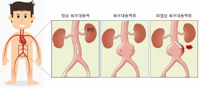 복부대동맥류 모식도. 사진 제공=서울대병원