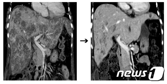 간에 생긴 염증이 검게 찍힌 CT 영상(왼쪽)과 치료 후 간농양이 호전된 CT 영상/(서울성모병원 제공)