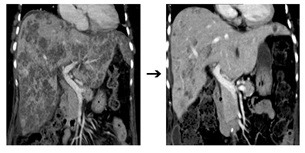간에 생긴 염증이 검게 찍힌 CT 영상(왼쪽)과 치료 후 간농양이 호전된 CT 영상