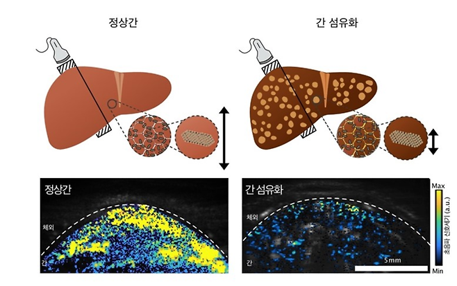 ‘나노 자성-버블(MGV)’을 체내에 주입한 뒤 찍은 실험용 쥐의 정상간(왼쪽 사진)과 간 섬유화가 진행된 간(오른쪽 사진)의 모습. 기초과학연구원(IBS) 제공