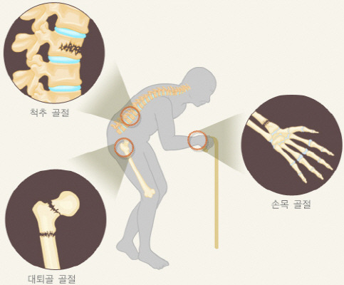 골다공증 환자에게서 골절이 잘 발생하는 부위(출처=국가건강정보포털).