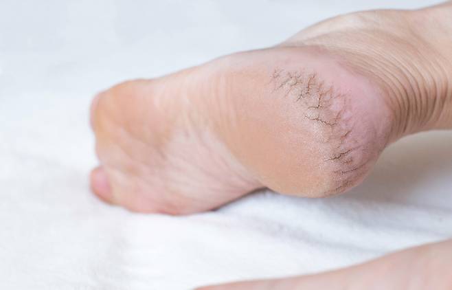 거칠게 각질이 일어나고 갈라진 발뒤꿈치에 상처가 생기면 당뇨발로 진행될 위험이 있으므로 꼼꼼한 보습이 필요하다. [사진= 게티이미지뱅크]