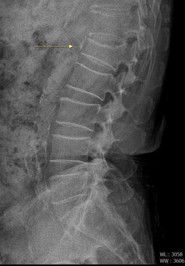 척추압박골절 환자의 엑스레이 영상. 화살표 부위의 척추뼈가 눌려져 있다.