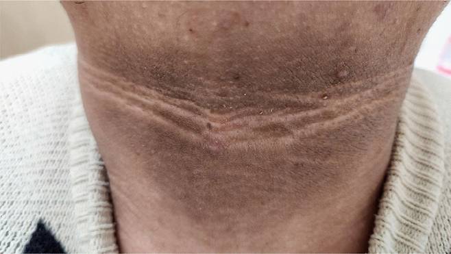 혈당 수치가 높아 인슐린이 과도하게 분비되면 목, 겨드랑이 등이 피부가 거칠어지며 착색이 발생하는 '흑색극세포증(흑색가시세포증)'이 발생할 수 있다./사진=한국당뇨병저널(The Journal of Korean Diabetes)