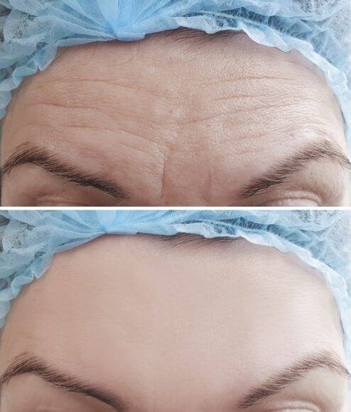 세월 따라 깊어지는 주름, 정기적으로 보톡스를 맞아 예방할 수 있다. [사진=게티이미지뱅크]