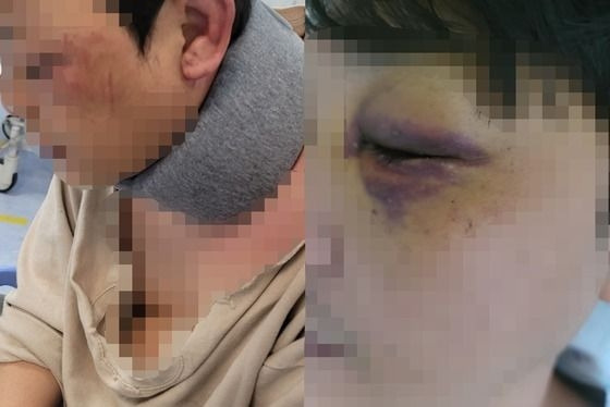 지난달 22일 경기 김포시의 한 아파트 단지에서 또래 아이의 아버지에게 폭행당했다는 A씨 남편의 피해 모습. 온라인 커뮤니티 갈무리