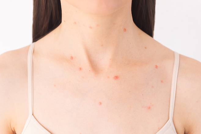목에 나는 여드름은 보기에도 좋지 않지만 피부가 얇은 탓에 짜내고 관리하기도 쉽지 않다. [사진=게티이미지뱅크]