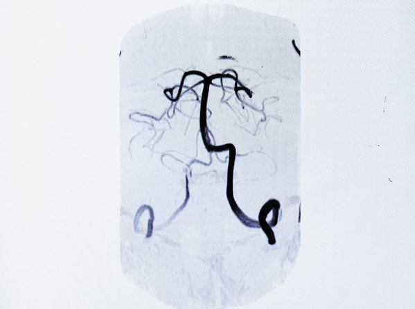 심한 두통을 호소하여 시행한 후두부 뇌혈관 박리 환자(A씨)의 뇌혈관 MRA.