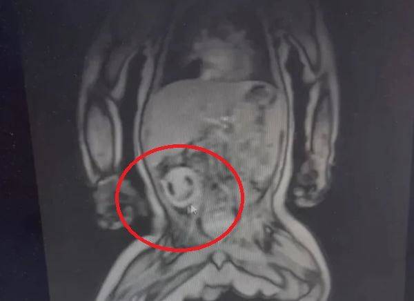 생후 4개월 된 남아 뱃속에서 기생 태아가 발견됐다. 이 기생 태아는 머리카락, 눈, 척추 등이 발달했으며 마치 미소짓고 있는 듯한 모습이다. [사진=웨이보 캡처]
