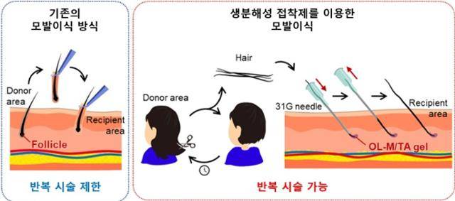 타닌을 활용한 생분해성 접착제 모발 이식 이미지. 카이스트 제공