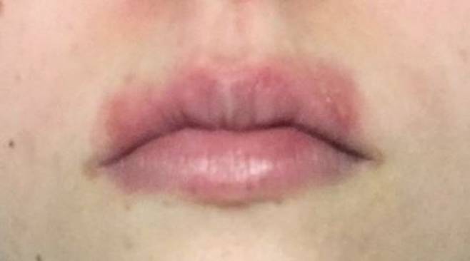 접촉입술염 예시./사진=논문 “Allergic contact cheilitis caused by propolis: case report”