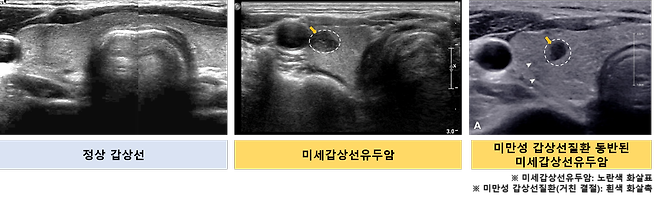 서울대병원 연구진이 갑상선 초음파 영상을 비교한 결과. 왼쪽부터 정상 갑상선, 미세갑상선유두암, 미만성 갑상선질환 동반된 미세갑상선유두암./서울대병원