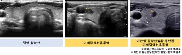 갑상선 초음파검사 비교. 서울대병원 제공