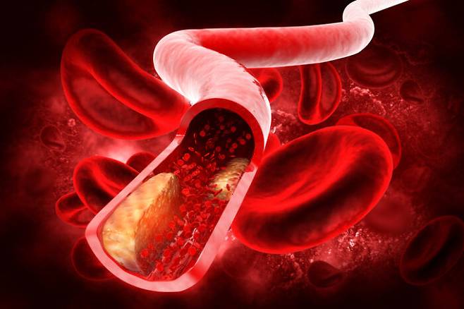 혈관질환, 당뇨병이 없는 한국인에게 최적의 콜레스테롤 치료 목표치를 확인한 연구 나왔다. [사진=게티이미지뱅크]