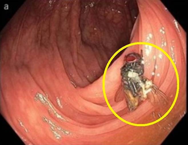 대장에서 발견된 온전한 형체의 파리 내용이 미국소화기학회지 최근호에 실렸다. 미국소화기학회지 제공