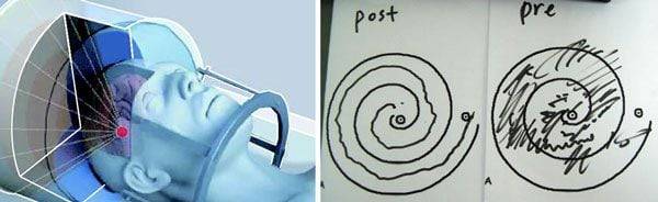 뇌 초음파 그래픽(왼쪽)과 시술 전후 환자 상태를 그린 그림이다. 수전증과 관련해 대뇌 속 특정 부위를 MRI로 타깃한 후 두개골 밖에 설치된 1000여 개의 초음파 발생기에서 해당 부위를 쏘아서 수전증 관련 신경회로를 차단한다. 오른쪽은 시술 전 환자가 심한 손떨림으로 달팽이 모양 선을 그려내지 못한 모습. 왼쪽은 시술 후 손떨림이 사라져 달팽이 선을 그대로 그려냈다. /세브란스병원 신경외과