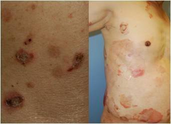 천포창. 서울아산병원 제공