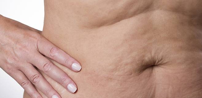 나이가 들면 뱃살 등 신체 곳곳 주름이 생긴다./사진=게티이미지뱅크