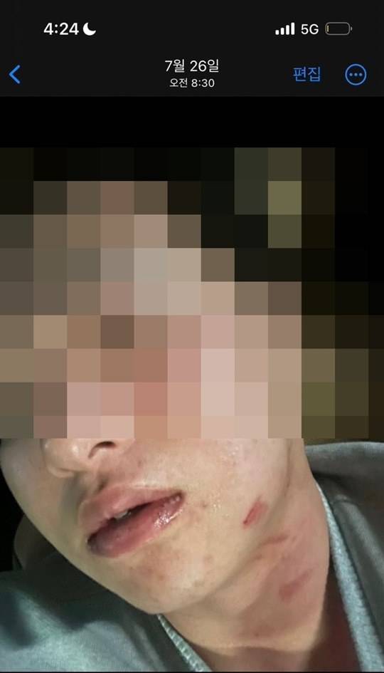 <사진 설명> 샌디에이고 김하성이 공갈 혐의로 경찰에 고소한 후배 야구선수 A씨. 폭행 직후 본인이 남겨 놓은 사진. (사진: A씨 변호인)