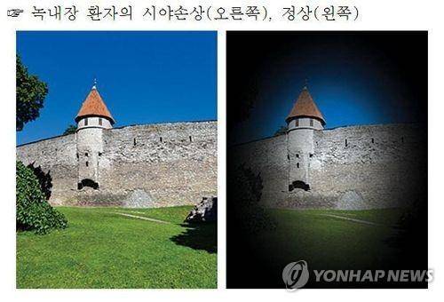 녹내장 환자의 시야손상 [서울대병원 제공]