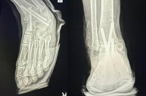 병원 실수로 멀쩡한 발목뼈를 절단해 철심 3개를 박은 모습복숭아뼈를 절단해 아래의 뼈들과 고정했다. 이 때문에 발목을 구부리거나 펴기가 어려워 정상적으로 걷지 못하게 됐다. [연합. A씨 제공]