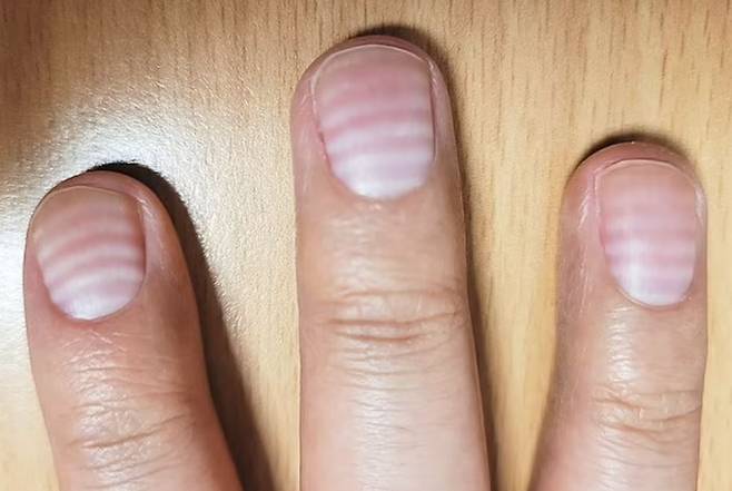 항암 치료의 부작용 중 하나인 백색손발톱으로 손톱에 흰색 선이 생긴 30대 남성./사진=영국 데일리메일