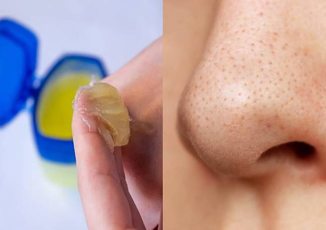 바셀린이 피지를 부드럽게 만들어 블랙헤드를 손쉽게 제거할 수 있다. [사진= 게티이미지뱅크]