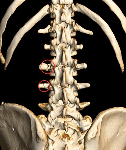 아반도의 부러진 요추 [안양 정관장 제공. 재판매 및 DB 금지]