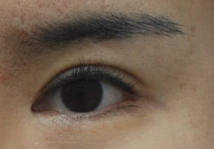 눈썹을 올려주지 않고 피부를 잘라내면 눈은 두껍고 강해 보일 수 있습니다.