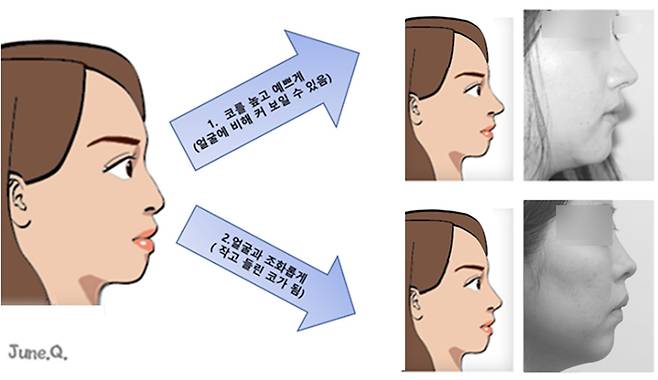 턱이 짧거나 뒤로 빠지면 예쁜 코도 길어 보입니다. 턱에 코를 맞추면 짧고 낮은 코가 됩니다.
