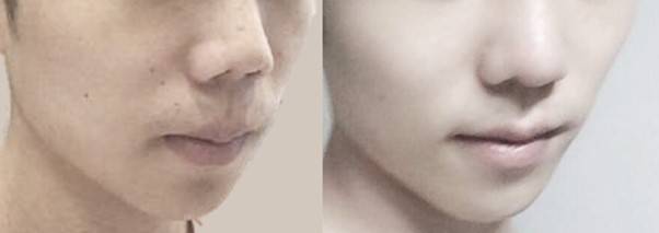 인중이 긴 것이 아니라, 코가 짧은 상태입니다. 짧은 코가 교정되면 인중의 느낌도 좋아집니다.