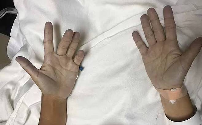 메트헤모글로빈혈증에 걸리면 산소 공급이 원활하지 않아 피부가 파랗게 변하는 청색증이 나타난다./사진=영국 데일리메일