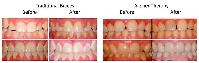 투명 교정 장치 환자는 철사 교정 장치 환자보다 백반 병변 발생률이 낮다 / 출처=앵글교정학회지