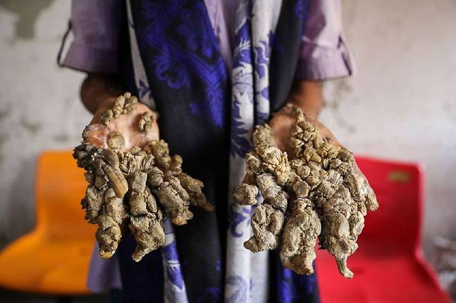 우취성 표피이상증은 지난 2019년 방글라데시에서 사는 아불 바잔달(28)의 사연이 공개되면서 화제가 됐다./사진=ABC