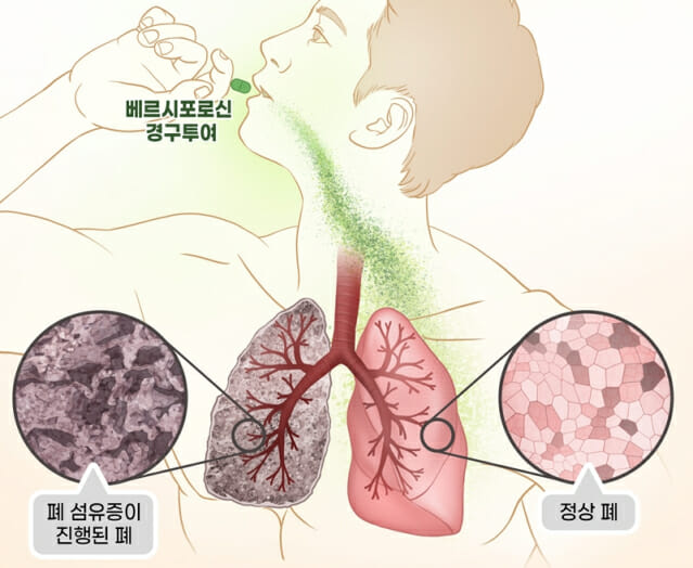 베르시포로신(DWN12088) 작용 기전. (그림=대웅제약)