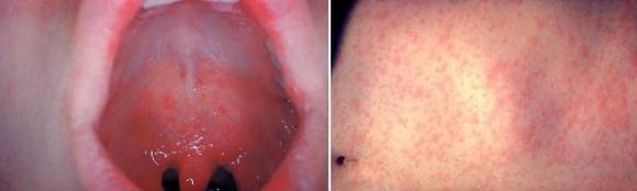 홍역에 감염되면 초기에 감기와 비슷한 증상이 생기다가 입속 반점과 피부 발진이 나타난다. 사진=질병관리본부