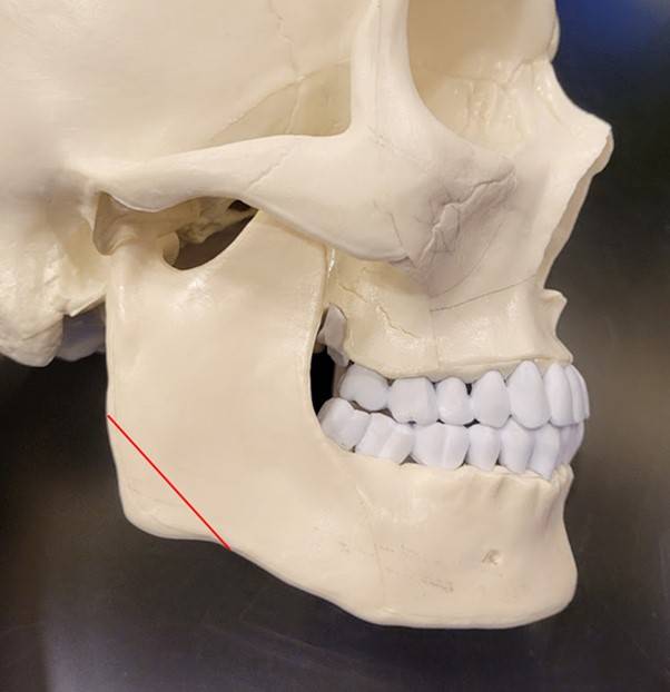 사각 턱 수술 초기인 90년대 초에는 '각(하악각, 귀밑각)'을 잘라 없애는데 집중했다.