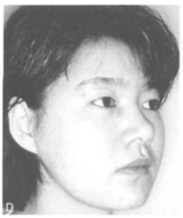 하악각(귀밑각)을 잘라 '개 턱'처럼 보이는 얼굴선. [사진=Aesthetic Plastic Surgery volume 19,93(1995)]