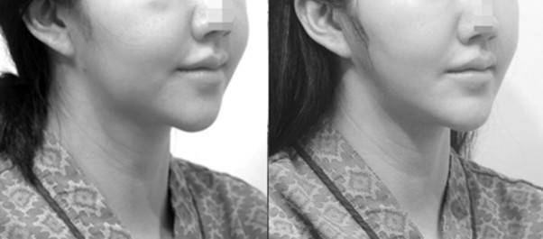 전체적으로 늘어진 살이 당겨주며 '개턱' 느낌도 완화되었다.