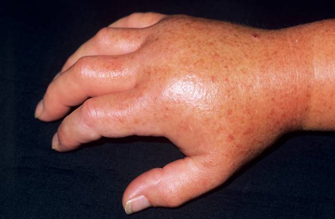 유전성 혈관부종(HAE)은 5만명 중 1명이 걸리는 희소 질환이다. 칼리크레인이라는 단백질이 과잉 생산되고 혈관 부종과 관련된 단백질 브래디키닌의 축적을 촉진해 입술과 입, 목, 장, 손, 발을 붓게 만든다. [사진=클립아트코리아]