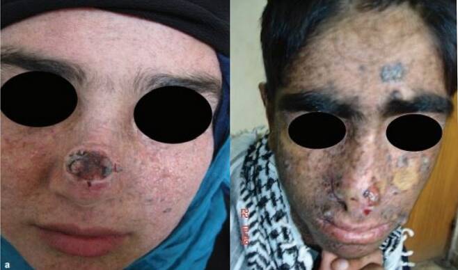 색소피부건조증을 겪은 21세 여성(왼쪽)과 16세 남성(오른쪽)의 모습./사진=Iranian Journal of Dermatology