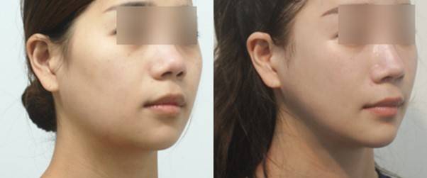 반면 '높게 위치하도록' 축소한 광대는 살의 처짐을 만들지 않습니다.