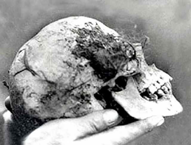 1943년 영국 웨스트미들랜즈주 해글리 숲 느릅나무 안에서 발견된 여성의 두개골. 출처 버밍엄메일