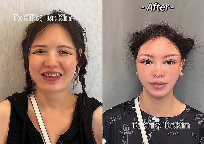 닥터 김이 올린 동영상에는 환자의 시술 전후 사진이 담겨 있다. 주로 안면거상술과 눈꺼풀 성형술(눈 주위의 여분의 지방 주머니를 제거하는 안검 성형술)이 포함돼 있다. [사진=데일리메일 보도 캡처]