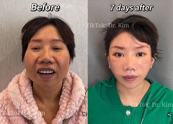 이슈가 된 영상에는 여러 남녀의 수술 후 일주일 정도 지난 후 피부가 매우 팽팽하게 당겨진 듯한 얼굴이 담겨 있다. 한 중년 여성의 얼굴은 수술 후 앳띤 아이가 된 모습이다. [사진=데일리메일 보도 캡처]