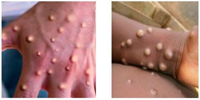 원숭이두창으로 인한 수포성 발진(왼쪽)과 수두의 수포성 발진./사진=Diagnostics 제공