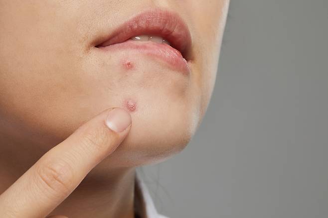 성인기 여드름은 스트레스, 술, 화장, 면도가 주범이다. 피부과 치료를 받으면서 생활 습관을 교정해야 완화할 수 있다./사진=게티이미지뱅크